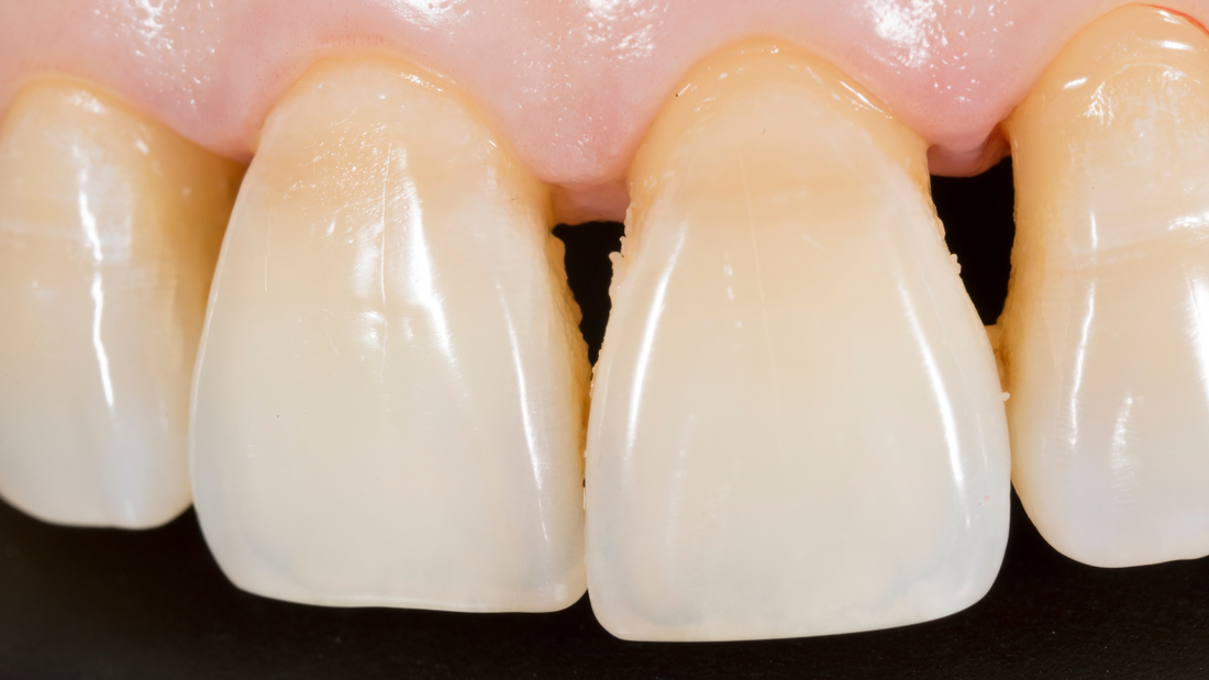 biofilm in mouth