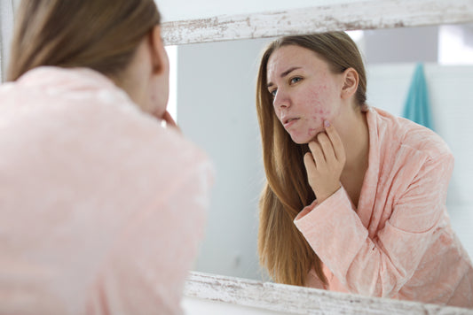 acne allergies