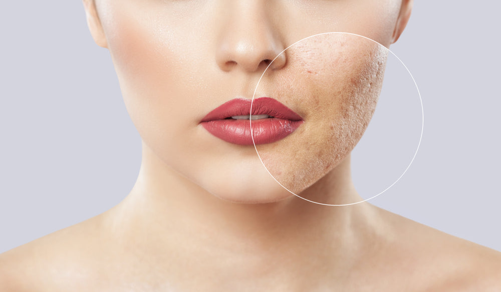 Liver Health and Acne Connection