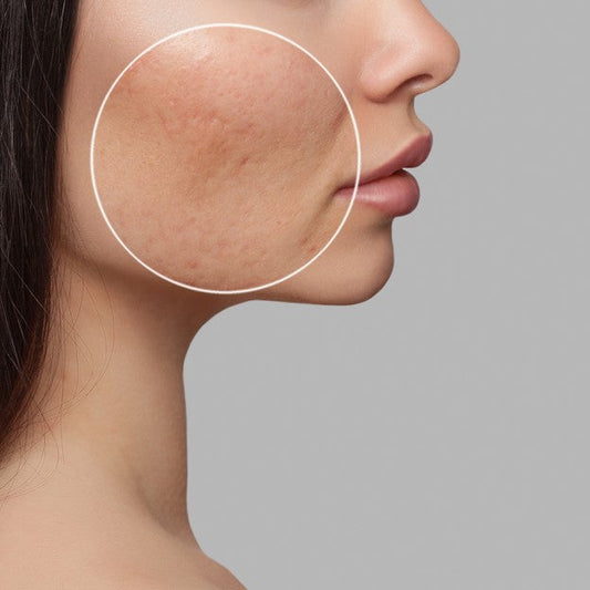 Fungal Acne Explained: Malassezia Folliculitis vs. Regular Acne + The Gut-Skin Connection