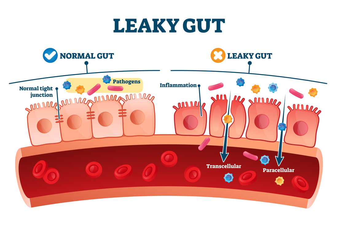 Best Foods and Worst Foods for Leaky Gut